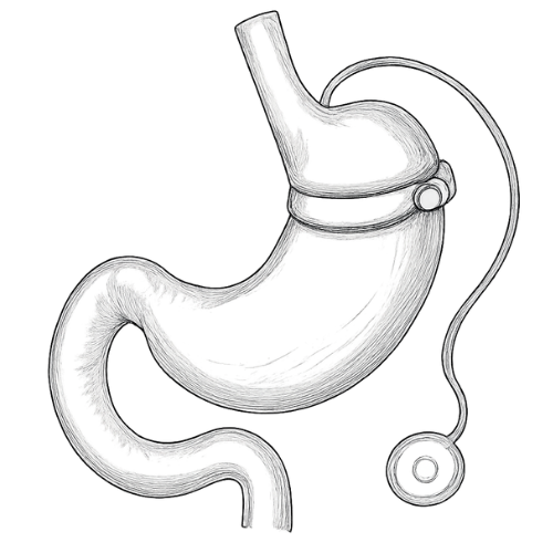 Virtuele maagband Hypnotherapie / hypnose